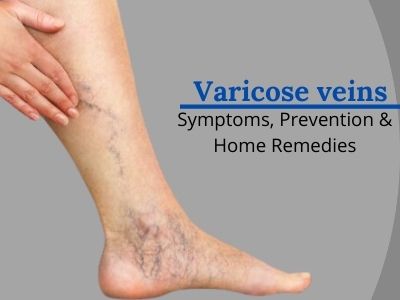 How to get rid of Varicose Veins? Treatment and Home Remedies ...